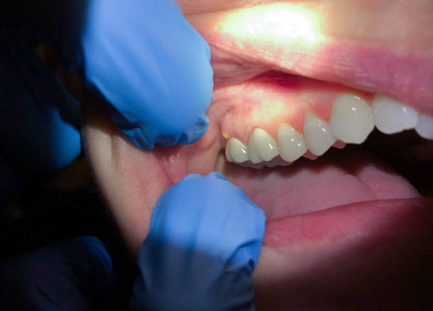 Best Broken or Chipped Tooth Repair in Watts Mills, SC