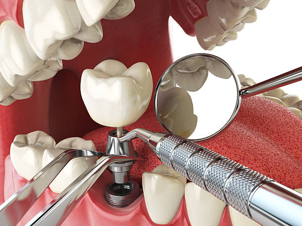 Best Knocked-Out Tooth (Avulsed Tooth) Treatment in Watts Mills, SC